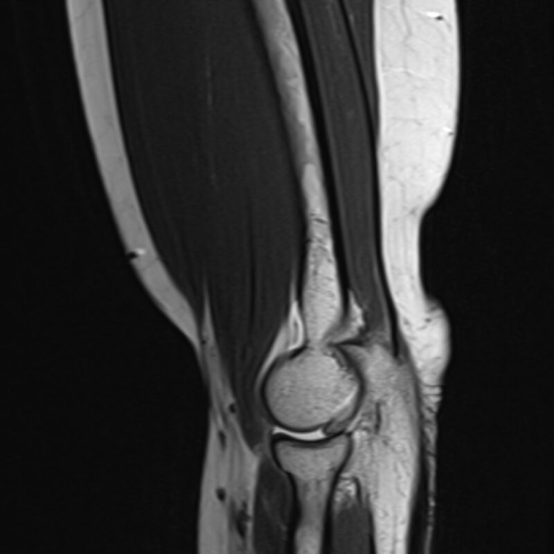 Magnetic resonance imaging of the elbow