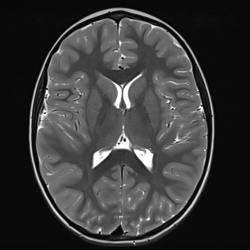 Magnetic resonance imaging of the brain