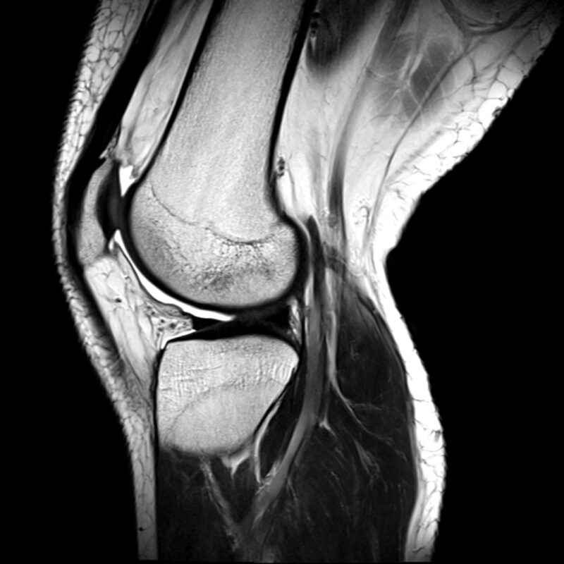 Knee MRI
