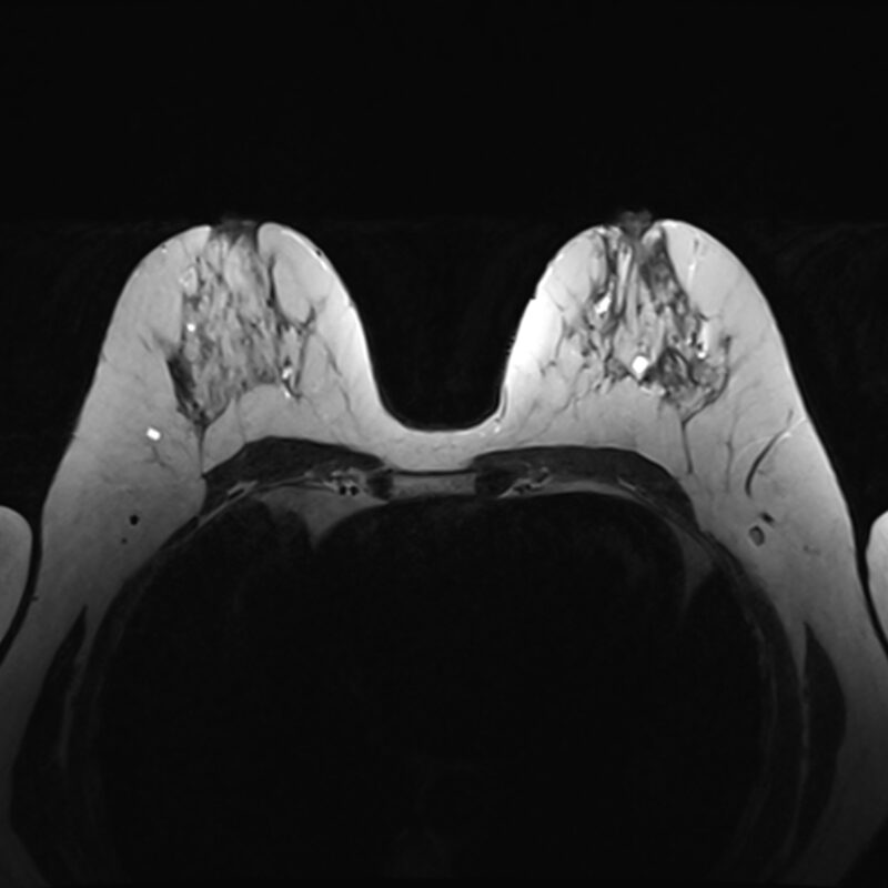 Breast MRI (MR Mammography)