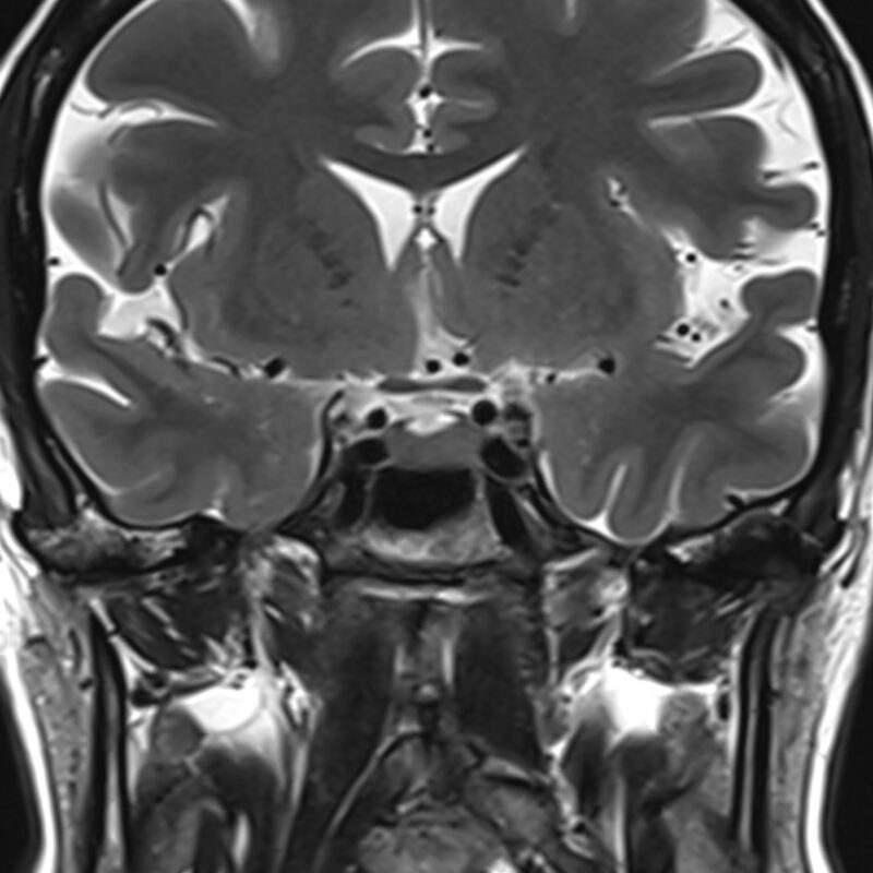 Magnetic resonance imaging of the pituitary gland