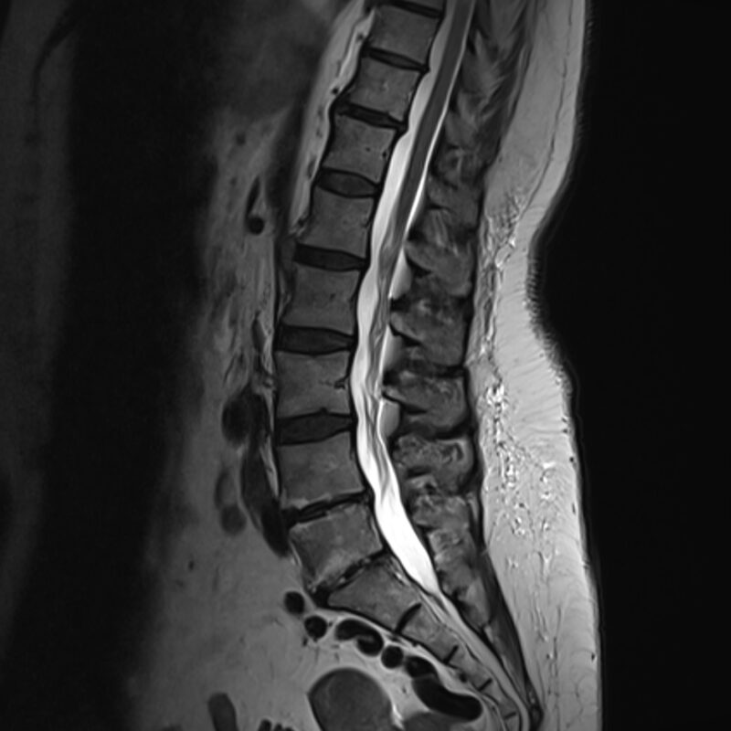 MRI of the lumbar spine