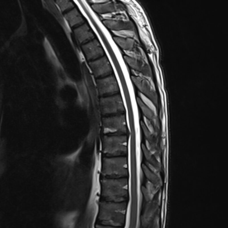 MRI of thoracic spine
