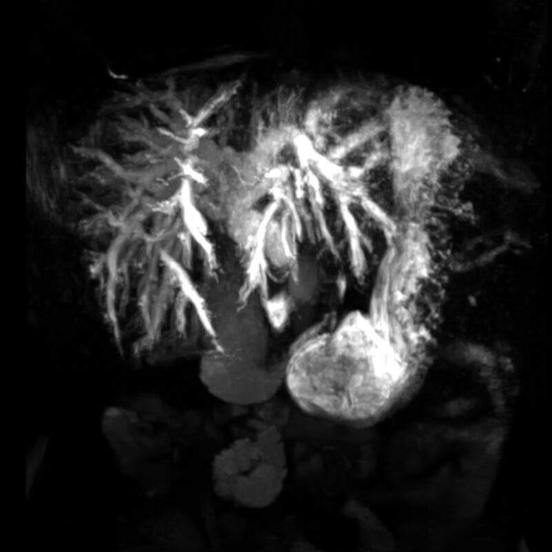 MRI of the abdomen and retroperitoneum