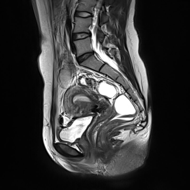 MRI of the rectum