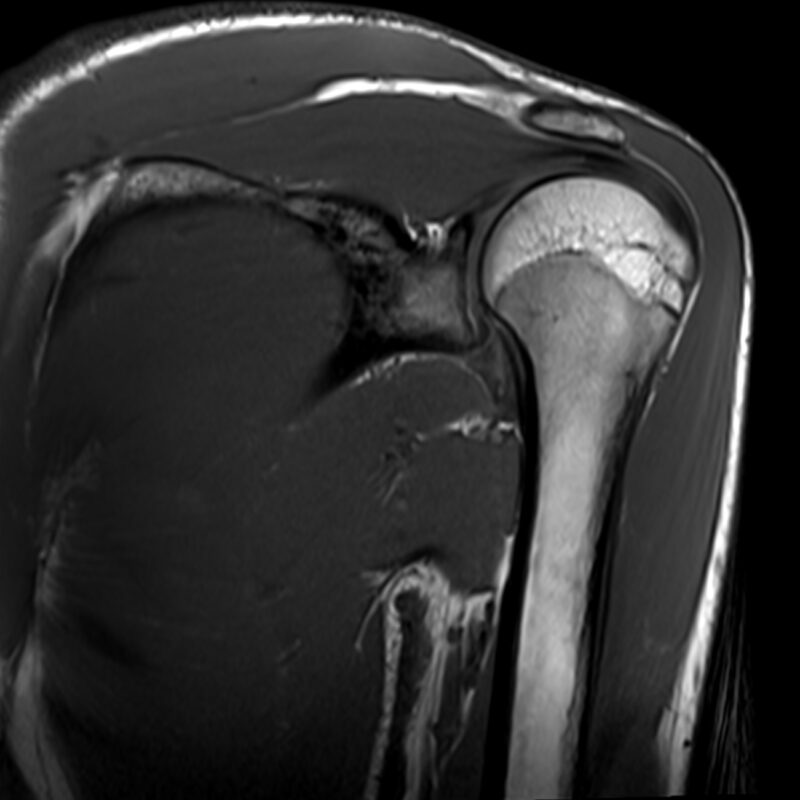 Shoulder MRI