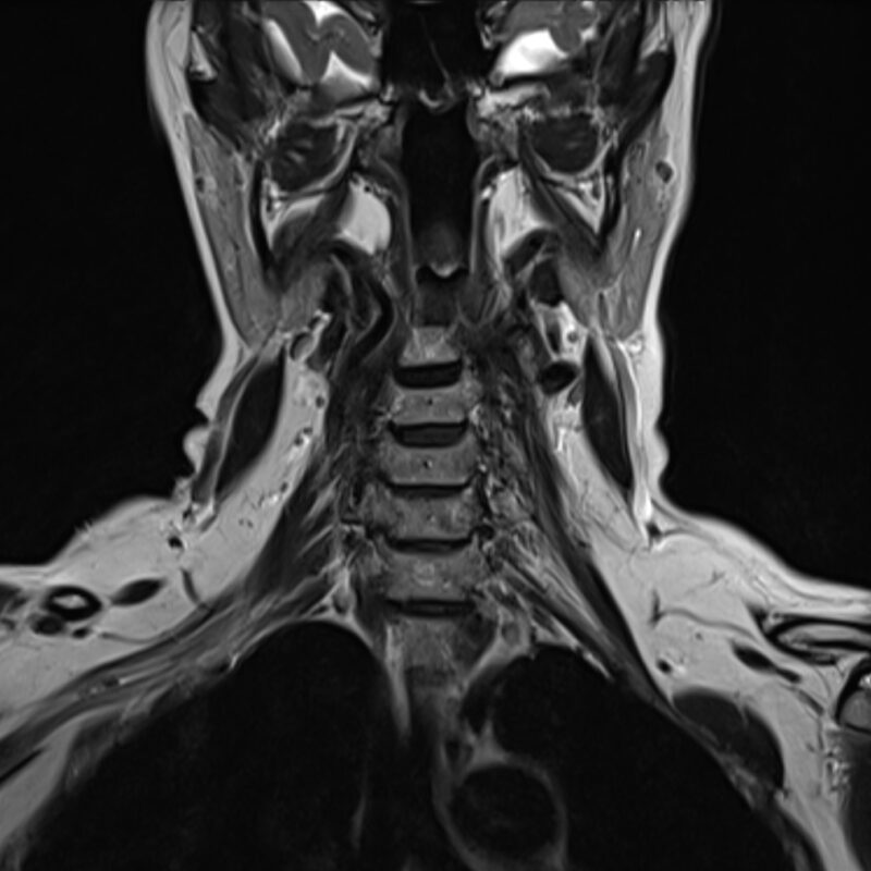 MRI of neck soft tissues