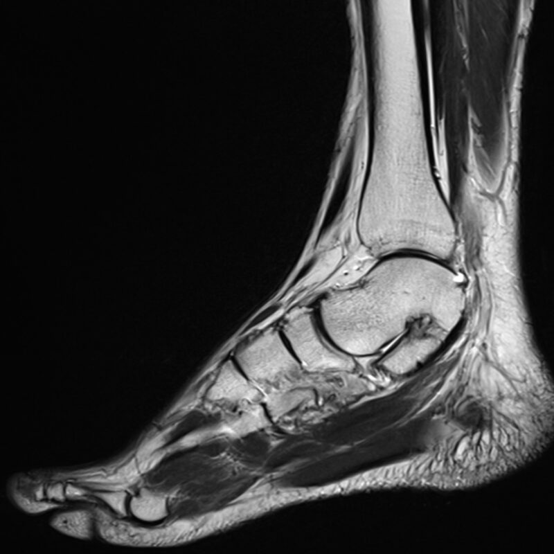 Magnetic resonance imaging of the ankle